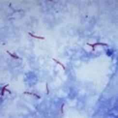 Mycoplasma Tuberculosis