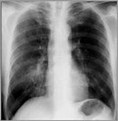 Mycoplasma Pneumonia