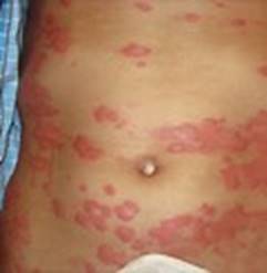 Mycoplasma Rash