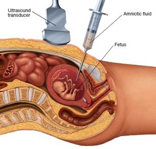 Image result for amniocentesis